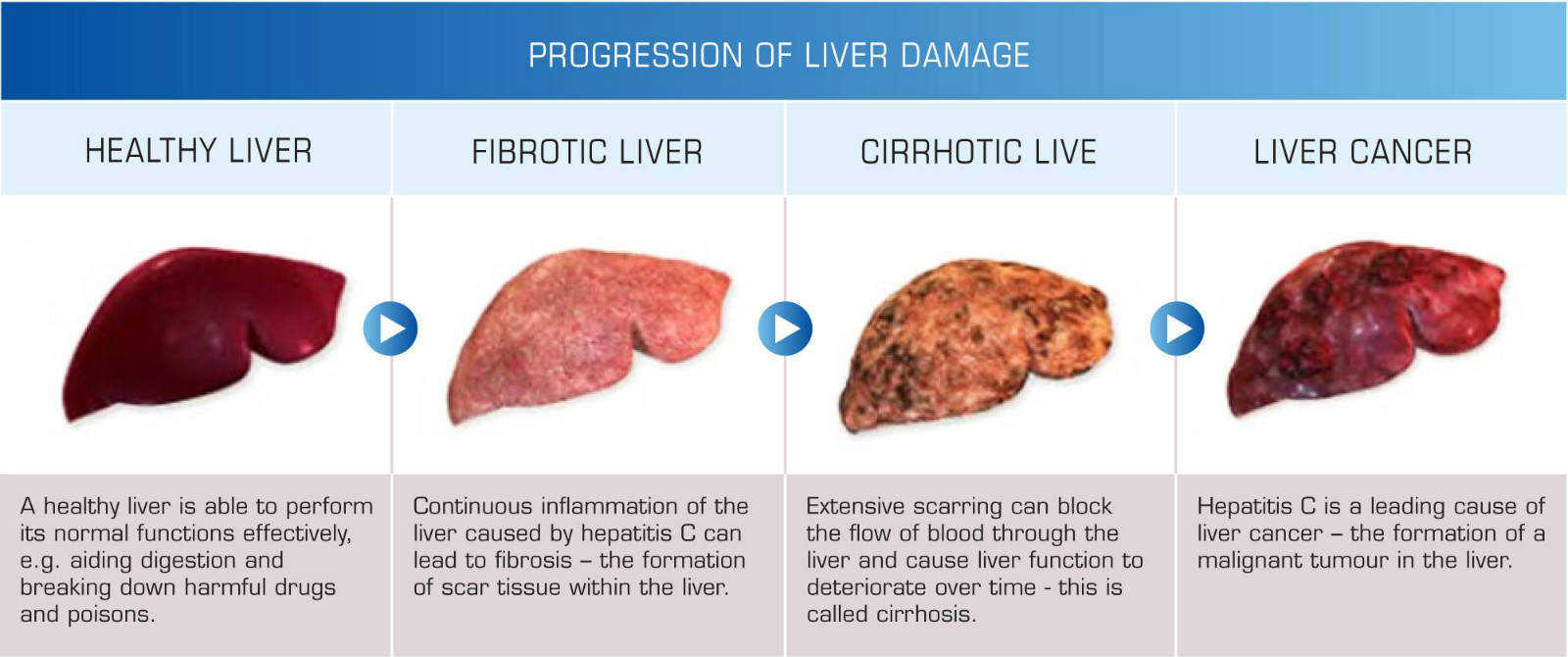 Progress-of-Liver-Damage